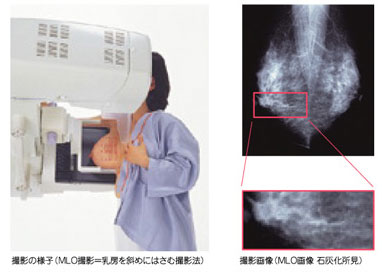 マンモグラフィー 